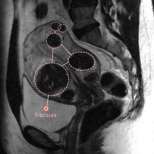 Fibroid diagnosis MRI