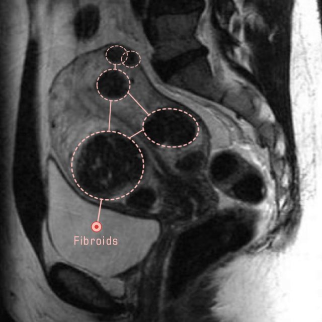 Как выглядит миома матки на мрт картинки