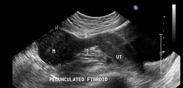 Fibroid diagnosis ultrasound