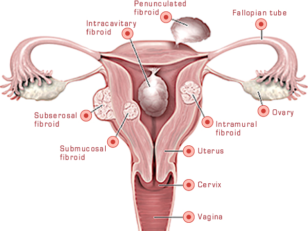 Fibroid symptoms