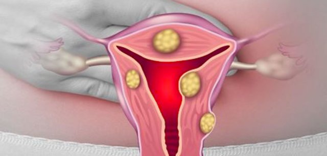 Fibroid symptoms heavy periods