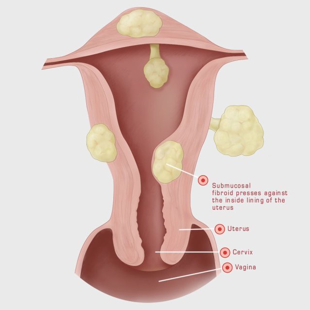 Fibroid symptoms heavy periods