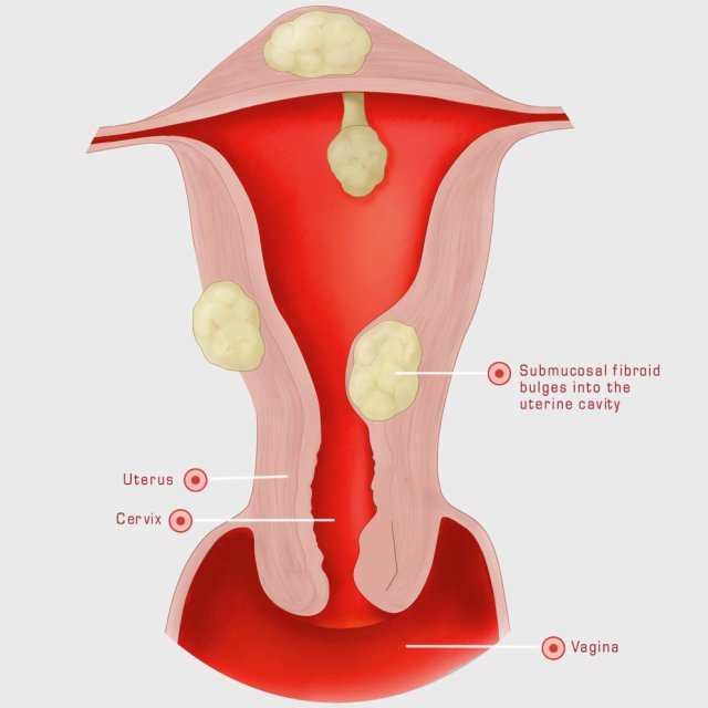 Fibroid symptoms pelvic pain