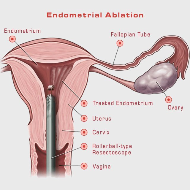 Fibroid treatment Endometrial Ablation