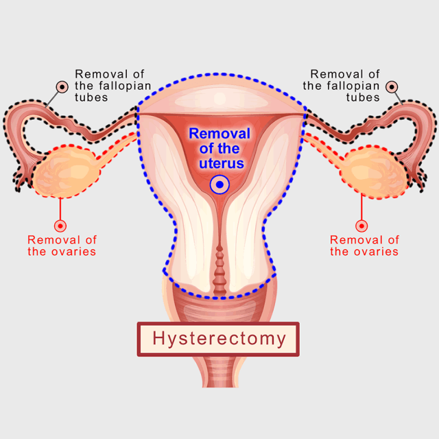 Hysterectomy