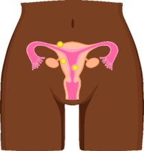 Fibroid Free female reproductive system Black women