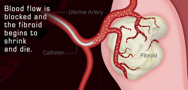 Fibroid treatment UFE