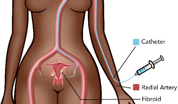 UFE fibroid treatment