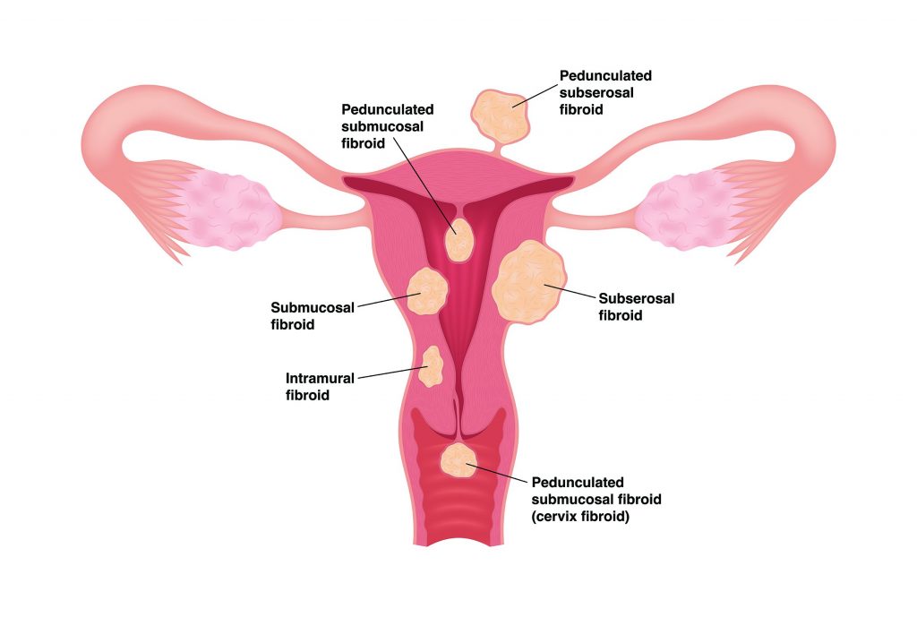 Types of uterine fibroids