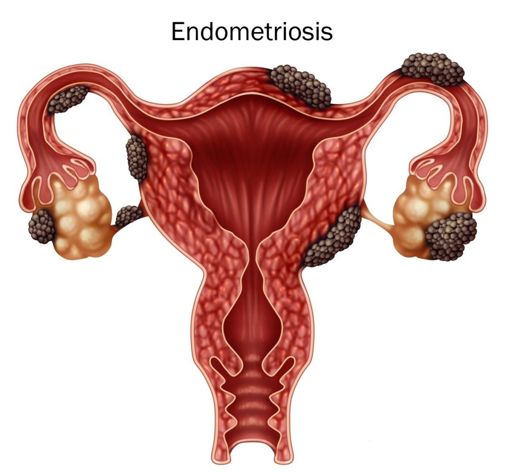 Endometriosis illustration