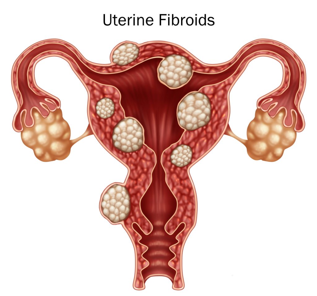 Uterine fibroids illustration