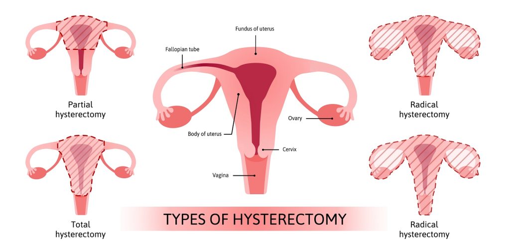 hysterectomy fibroid removal types of surgery