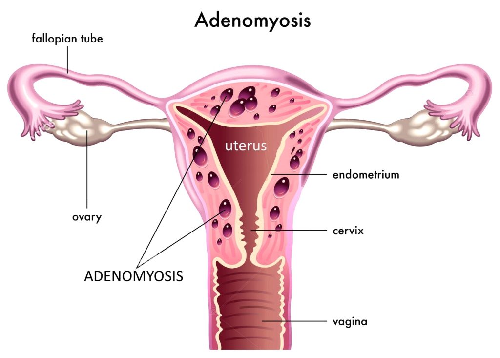 Adenomyosis and Fibroids