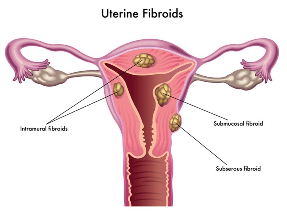 Adenomyosis and Fibroids