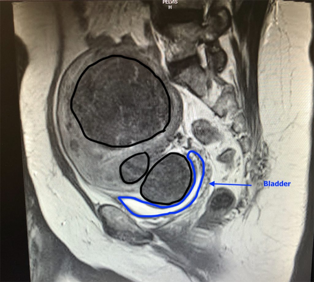 frequent urination fibroids pressing bladder