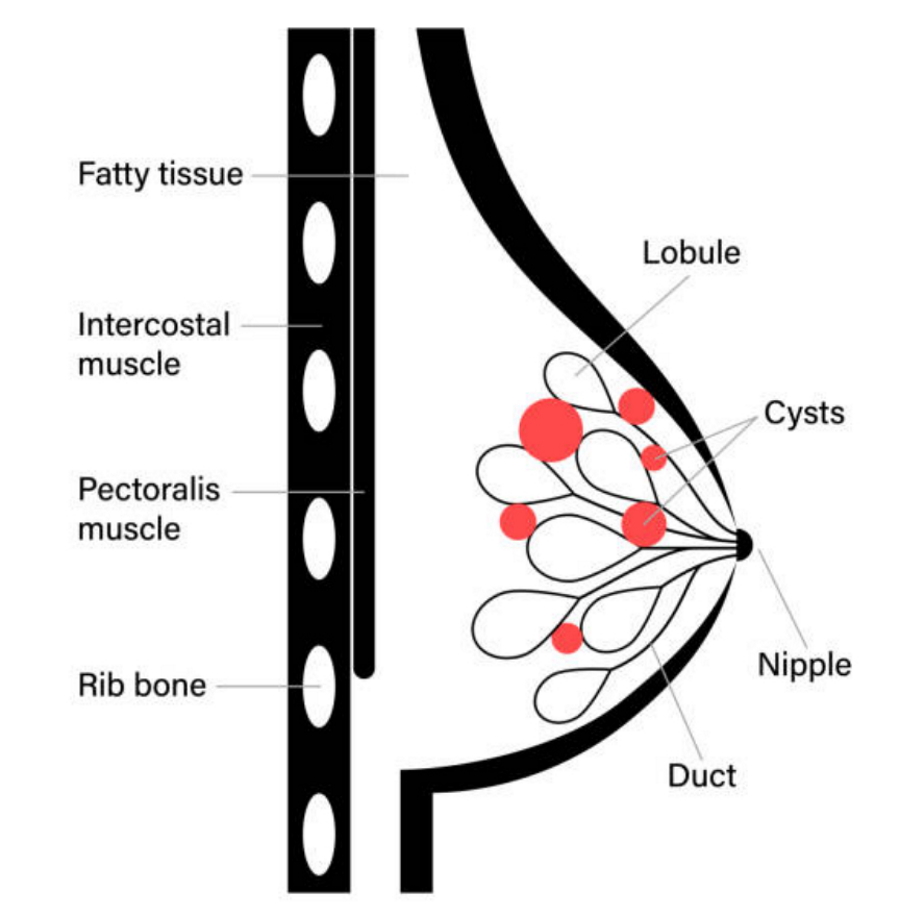 fibrocystic breast disease illustration