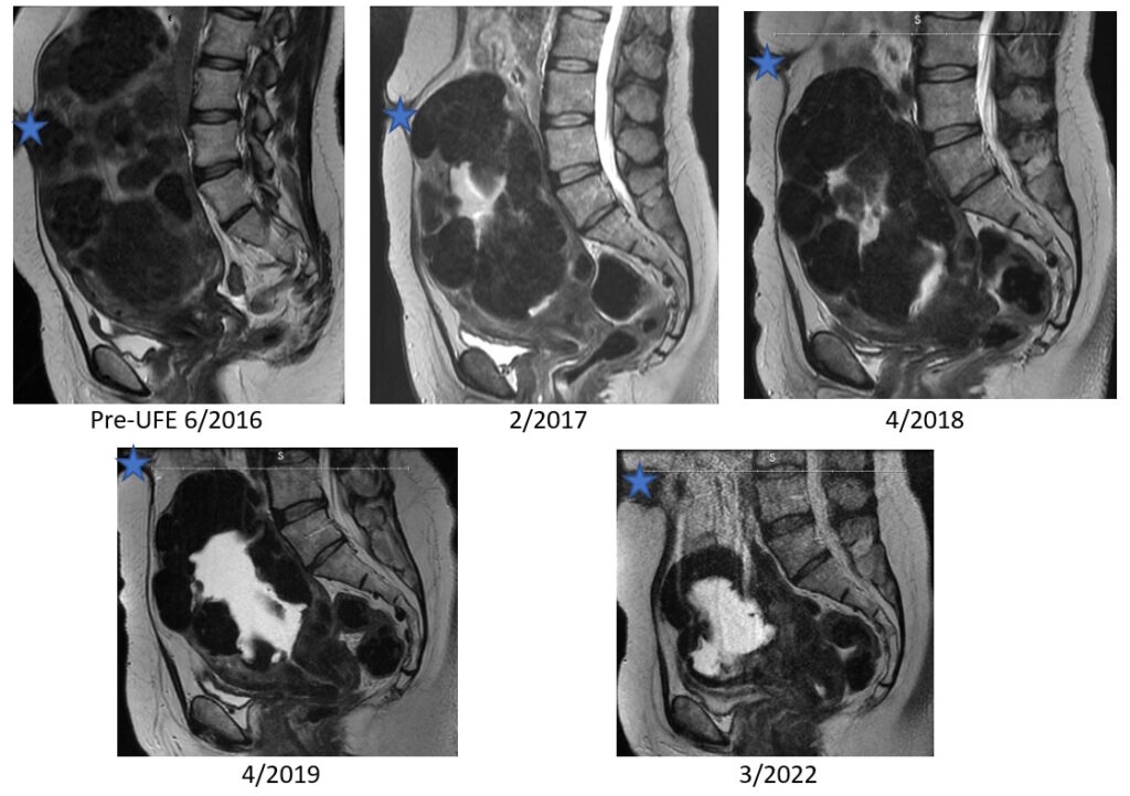 no hysterectomy, fibroids UFE MRI images