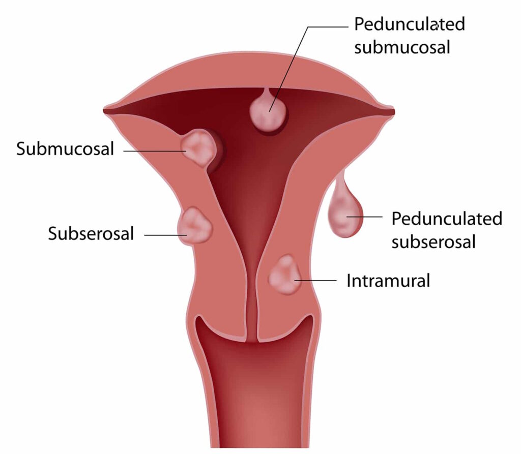 illustration fibroid types