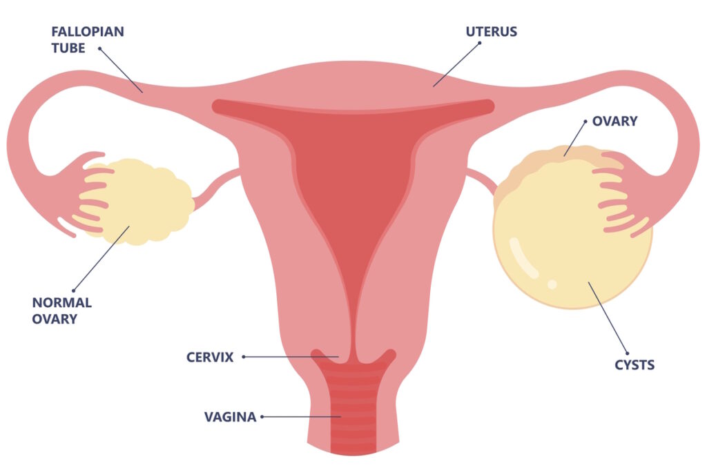 illustration ovarian cyst