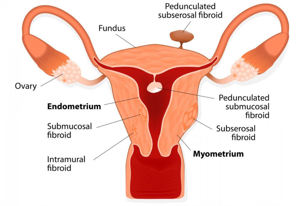 illustration uterine fibroids