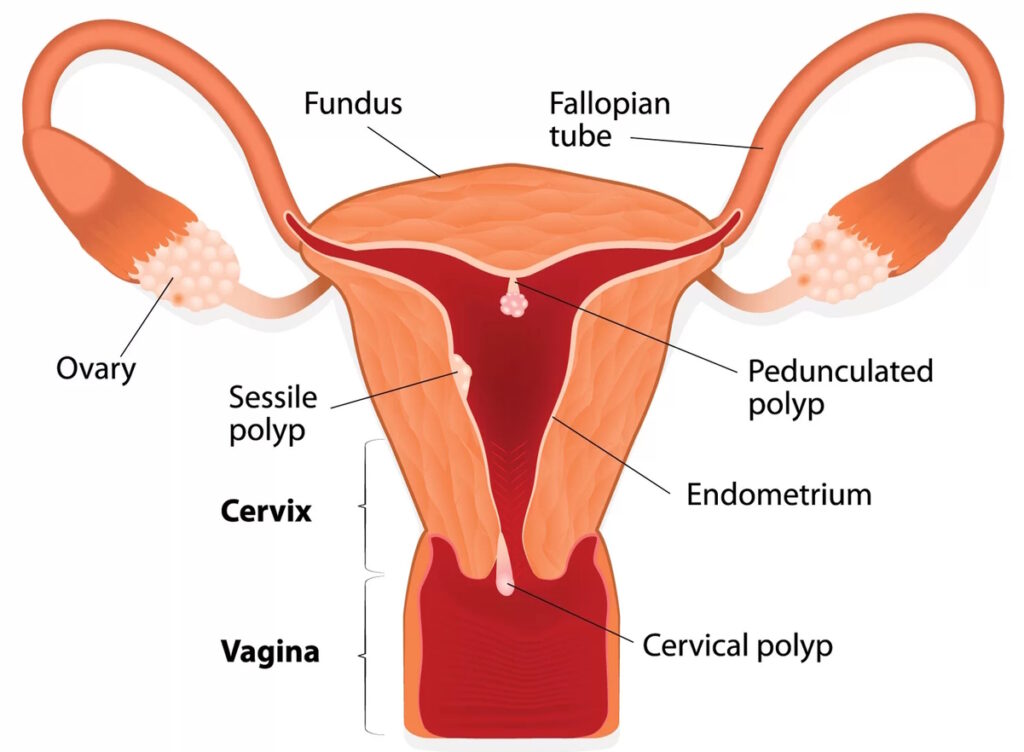 illustration uterine polyps