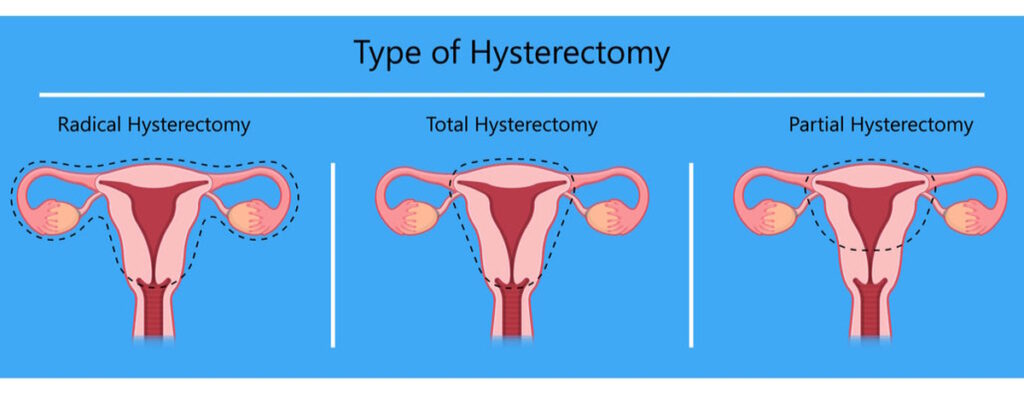 hysterectomy illustration types hysterectomy
