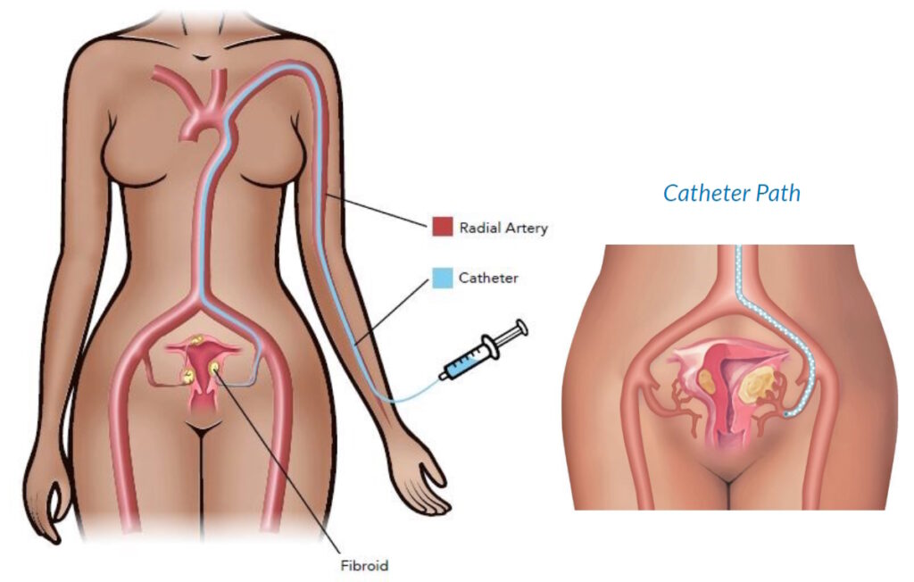 fibroid removal options for several uterine fibroids UFE illustration