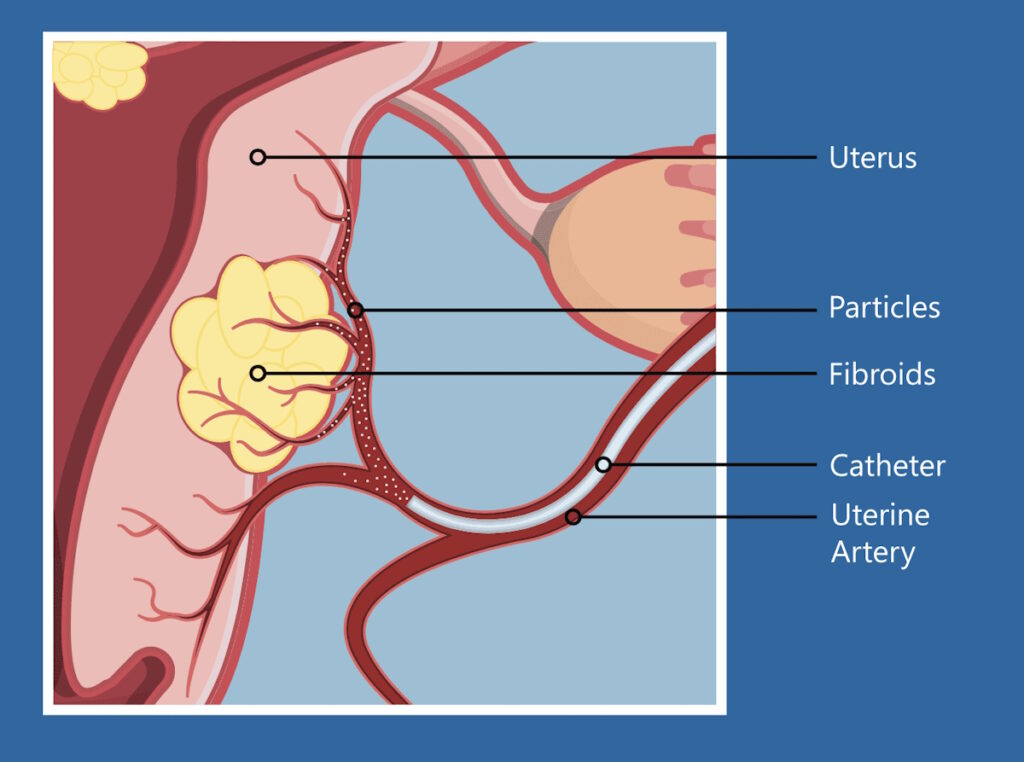 uterine fibroids illustration UFE