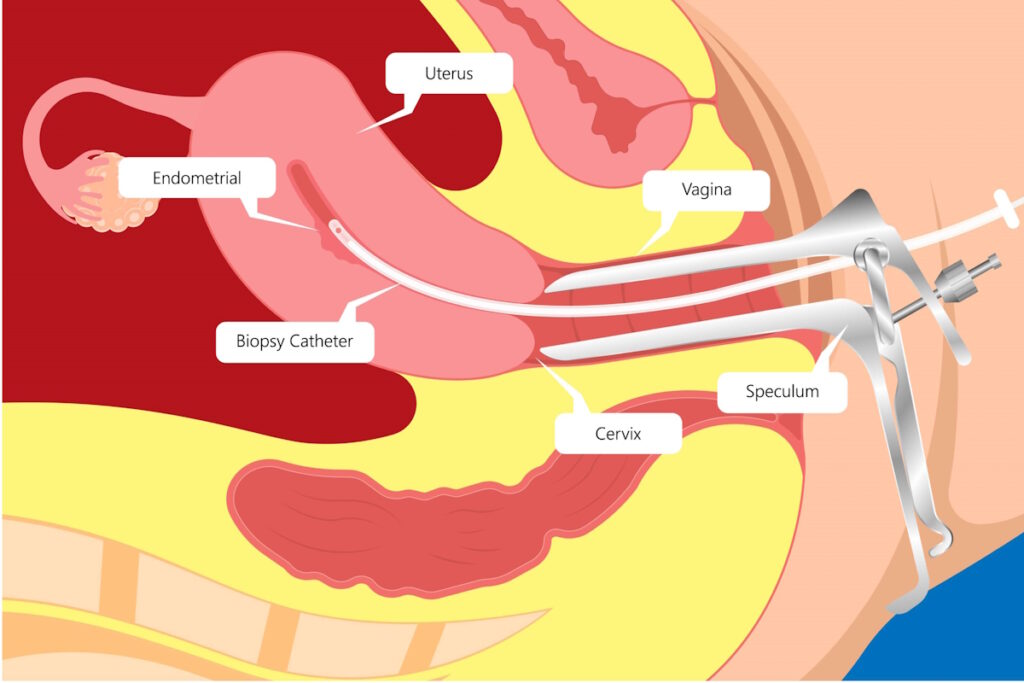 endometrial ablation ss1682636824