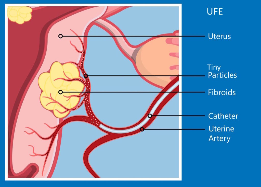 uterine fibroid embolization UFE illustration tiny particles