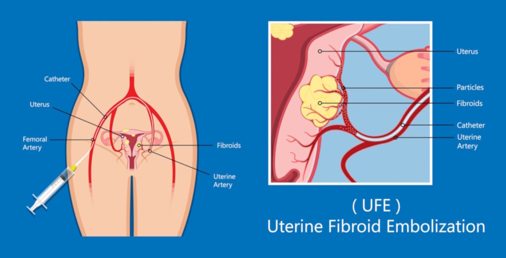 ufe fibroid embolization illustration groin