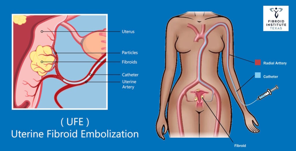 ufe fibroid embolization illustration wrist fibroidfree