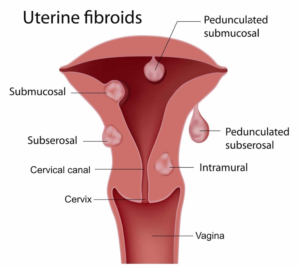 illustration fibroid types