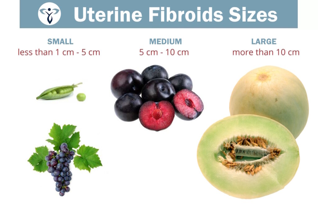 infographic sizes uterine fibroids fibroid institute