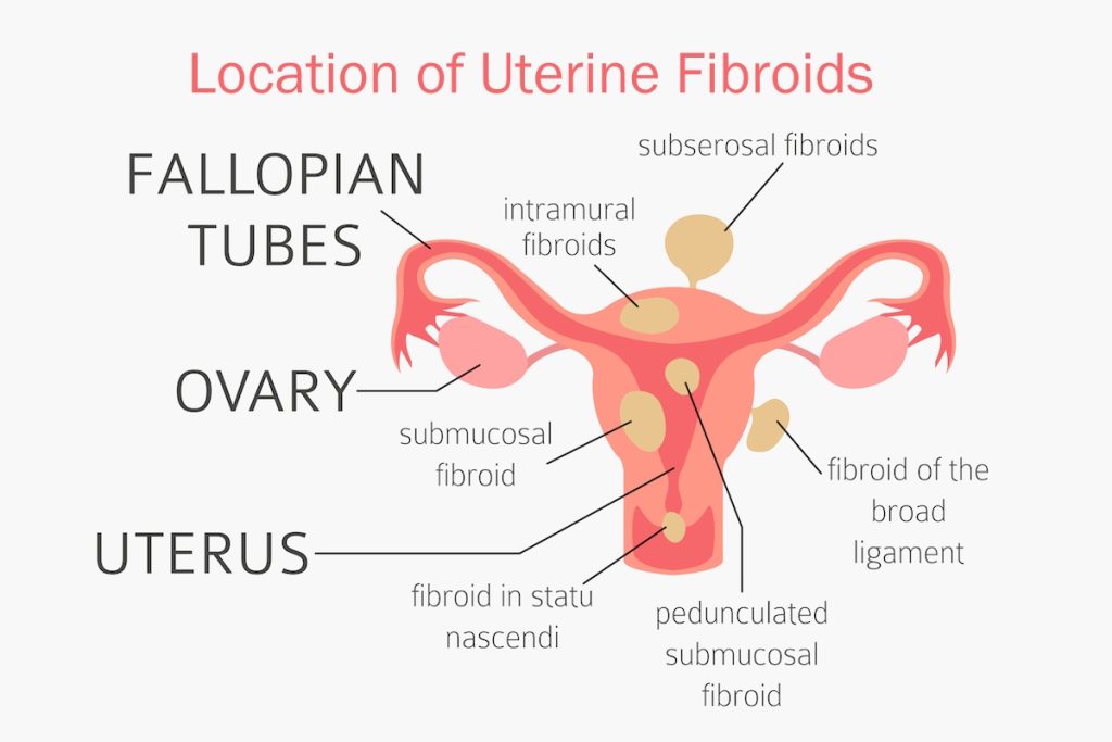 uterine fibroids pregnancy illustration fibroid location
