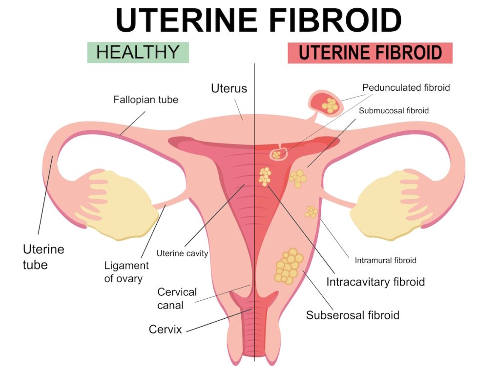 fibroid symptoms illustration uterine fibroids
