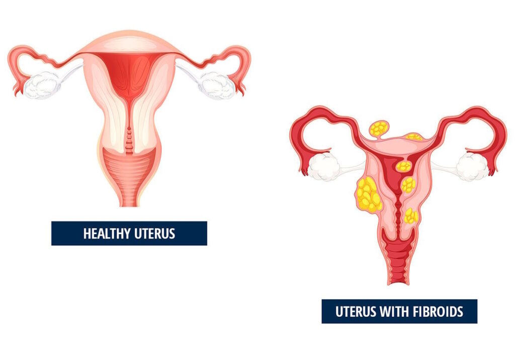 abnormal vaginal bleeding illustration uterine fibroids
