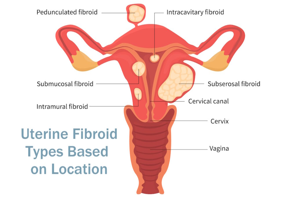 uterine fibroids fibroid treatment illustration uterine fibroids close up