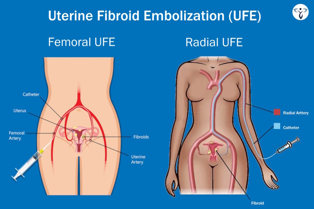 ufe illustration groin vs wrist