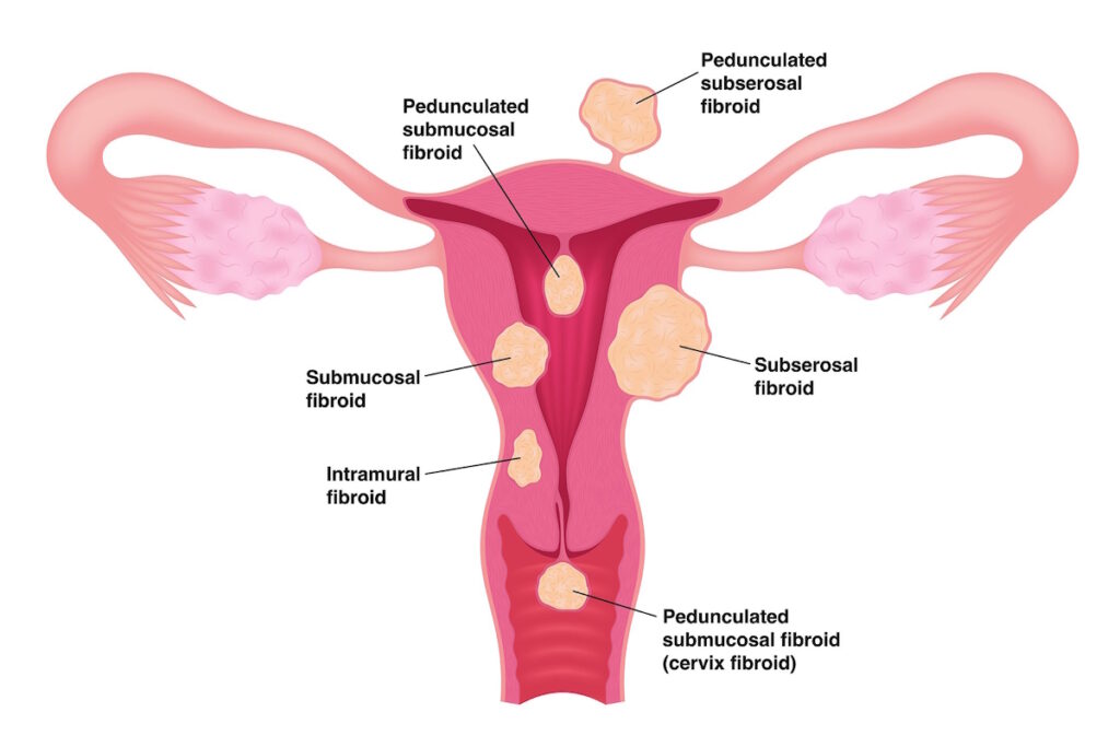 fibroid pain types of uterine fibroids