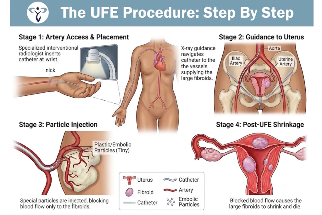 infographic ufe uterine fibroid embolization step by step fibroid institute
