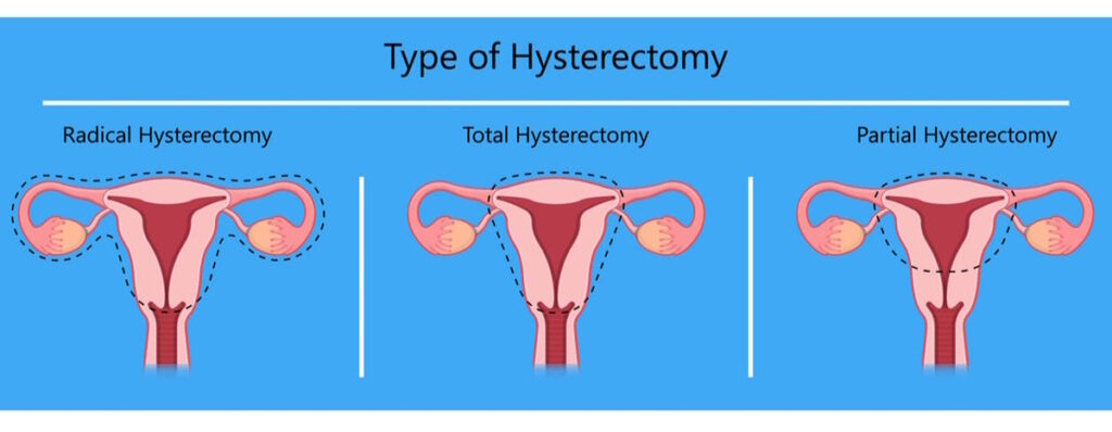 fibroid removal alternative illustration types hysterectomy
