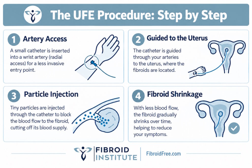 fibroid removal alternative ufe step by step infographic